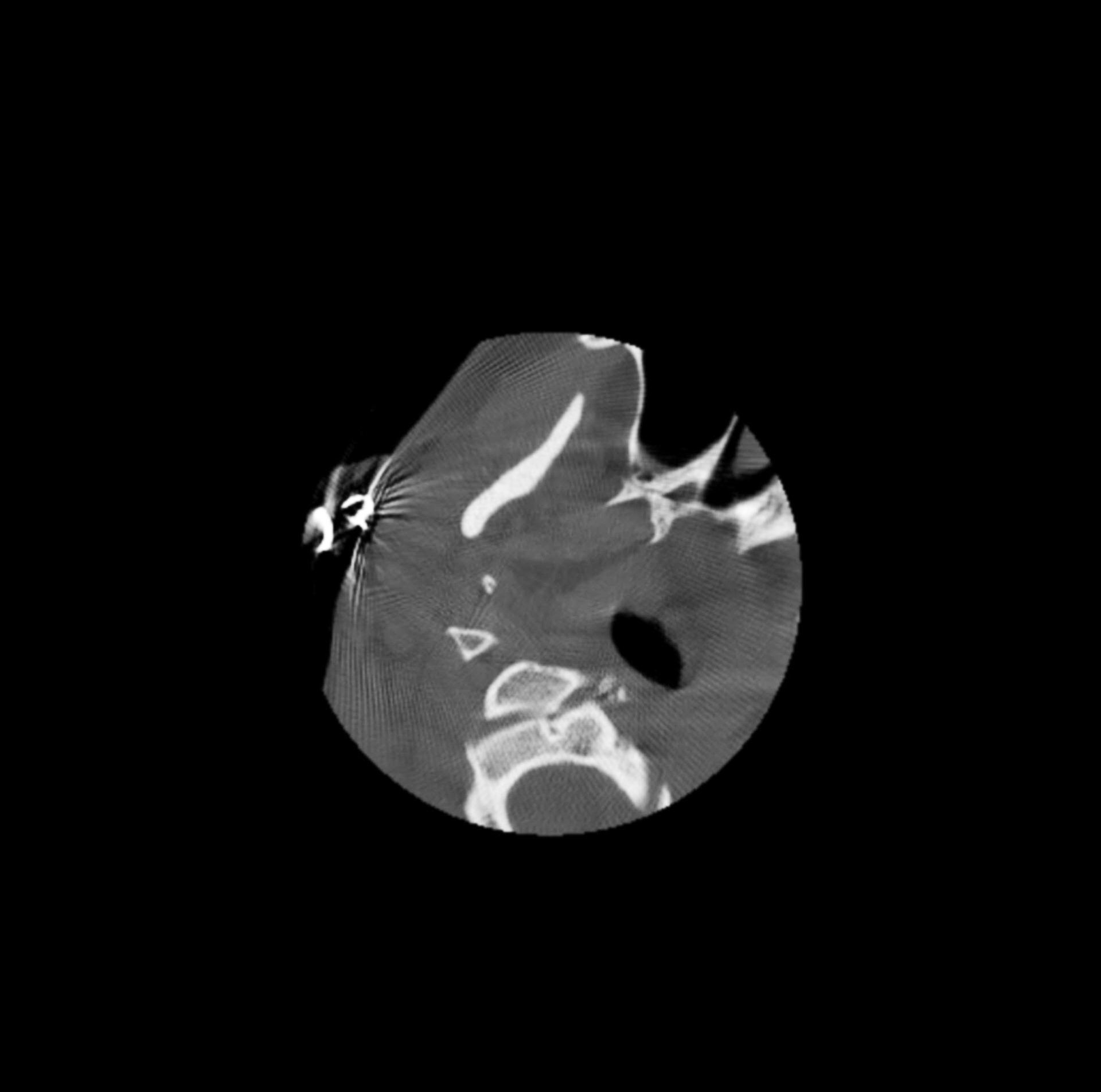 Axial CT scan of a human head and neck, showing bone structures and some soft tissue; brown and black tones.