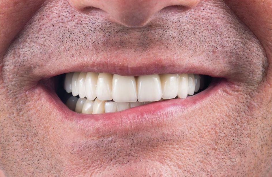 Dental Implant Supported Connecting Bar Get the Support You Need