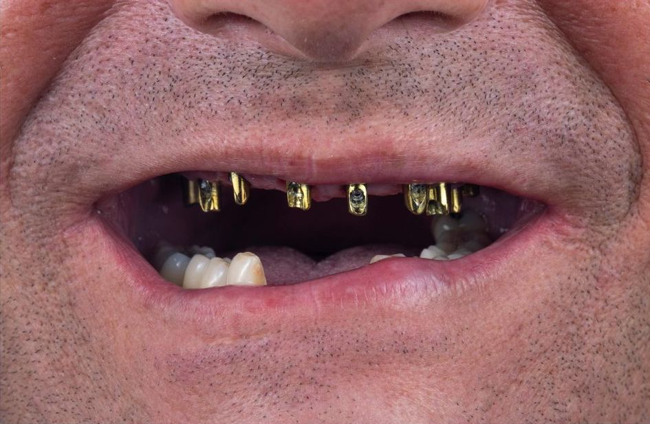 Dental Implant Supported Connecting Bar Get the Support You Need