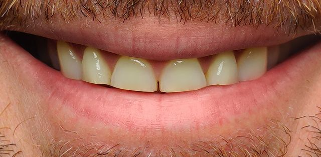 Before treatment