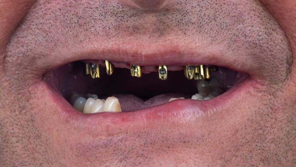 Before single tooth implant