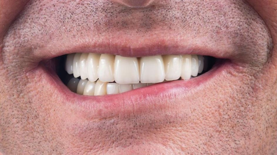 After single tooth implant