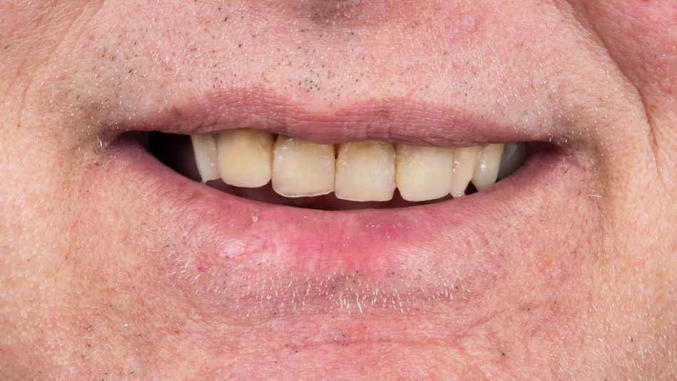 Before treatment