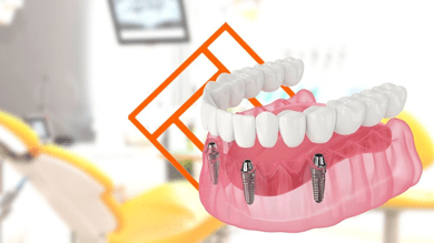 dental implants miami fl