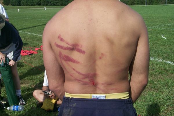 A shirtless man with a few bruises on his back
