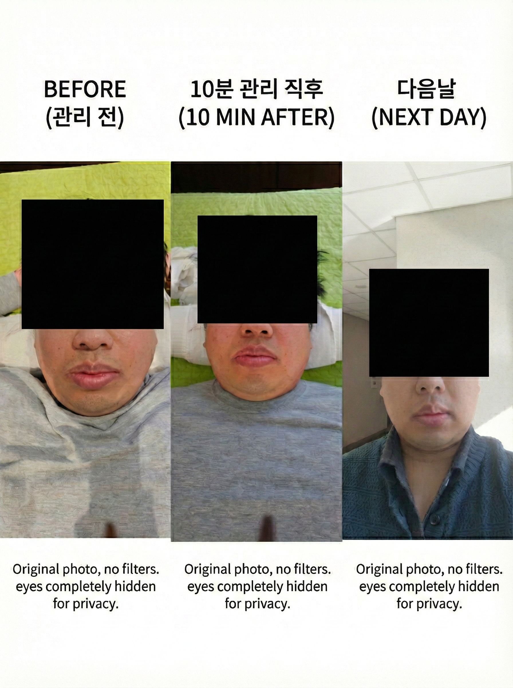 Swelling reduction results after facelift massage