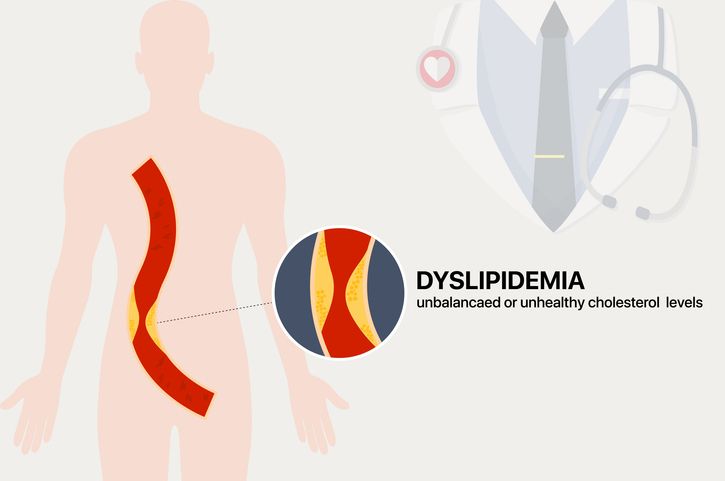 Artery with yellow plaque buildup restricting blood flow; red blood cells visible.
