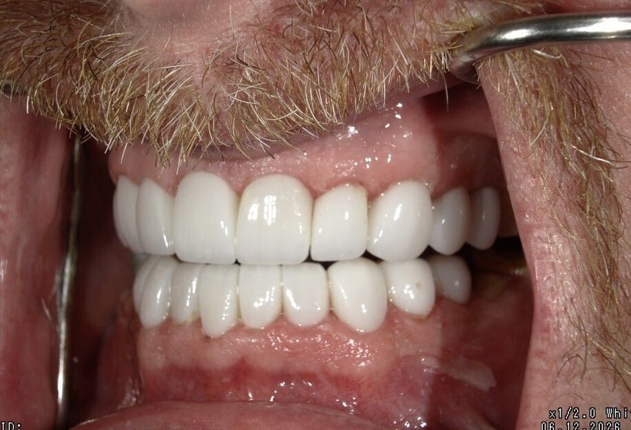 Close-up of a mouth showing bright white teeth with the lips pulled back.