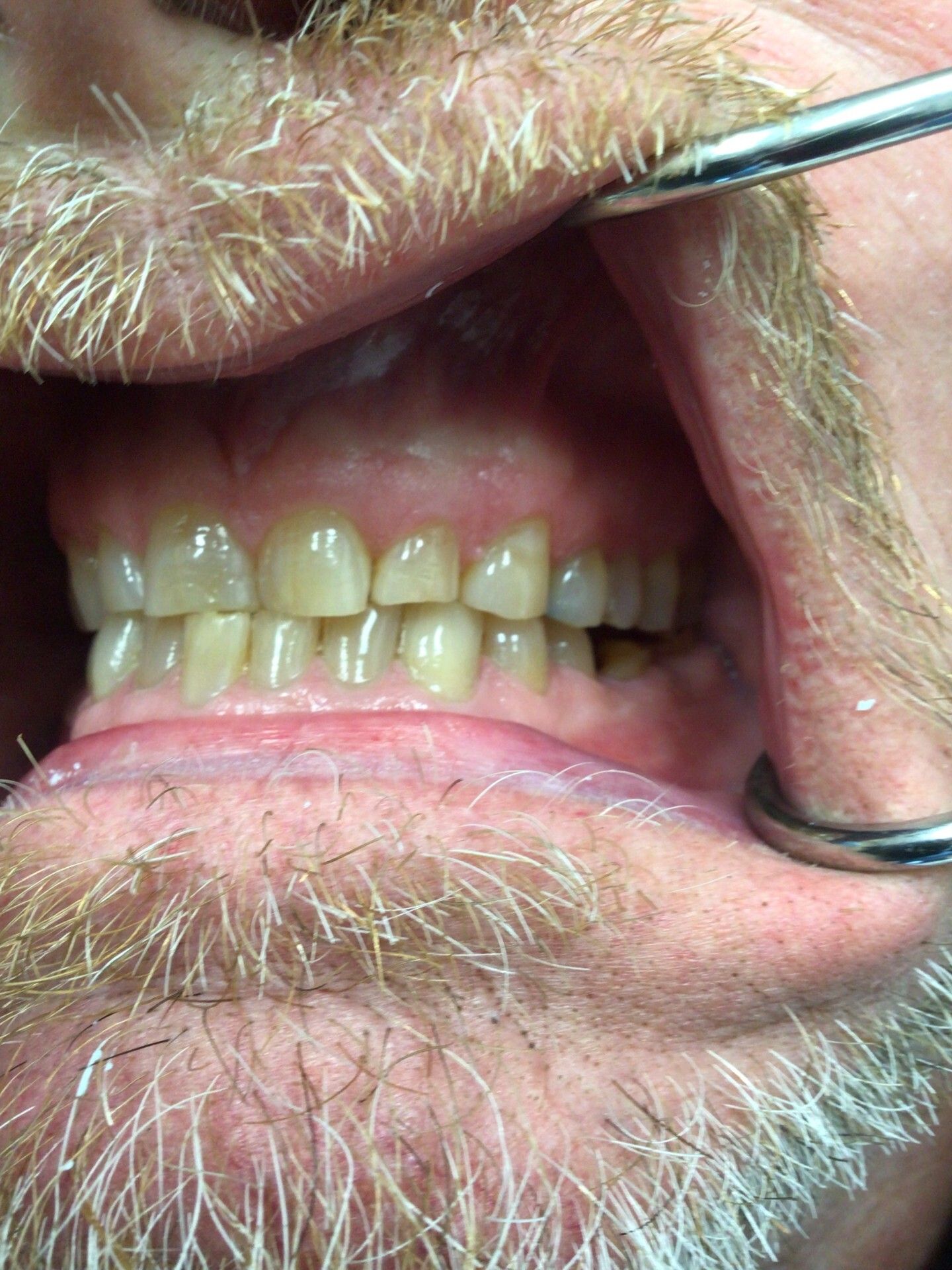 Close-up of a man's mouth with lips retracted, showing teeth and a dental cheek retractor
