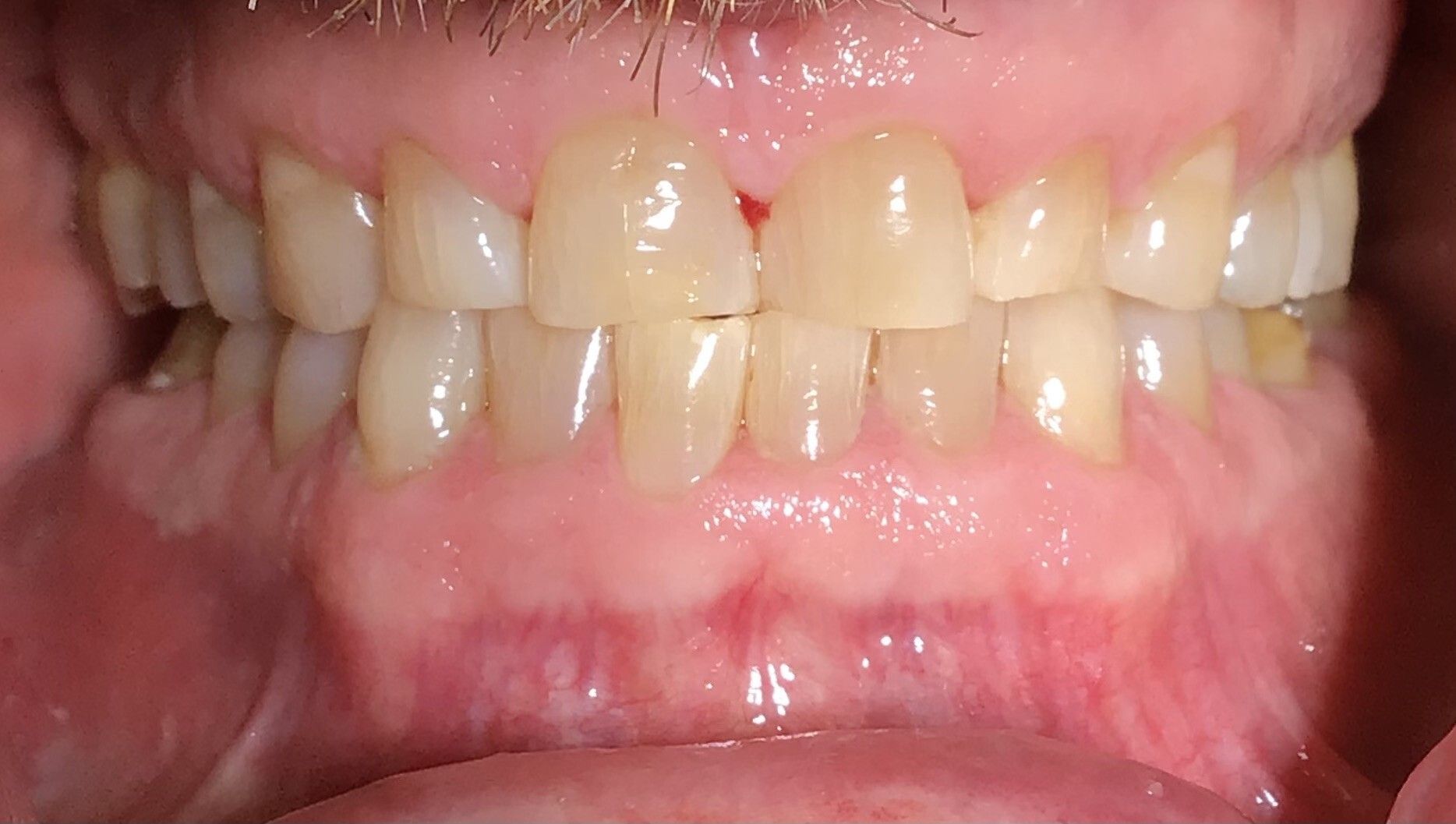 Close-up of a mouth showing upper and lower teeth with a small gap between the front teeth.