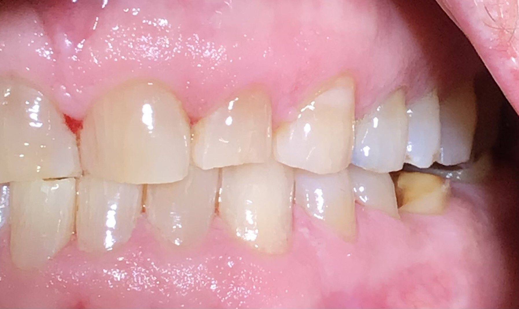Close-up of teeth with a visible gap and a small broken tooth near the back