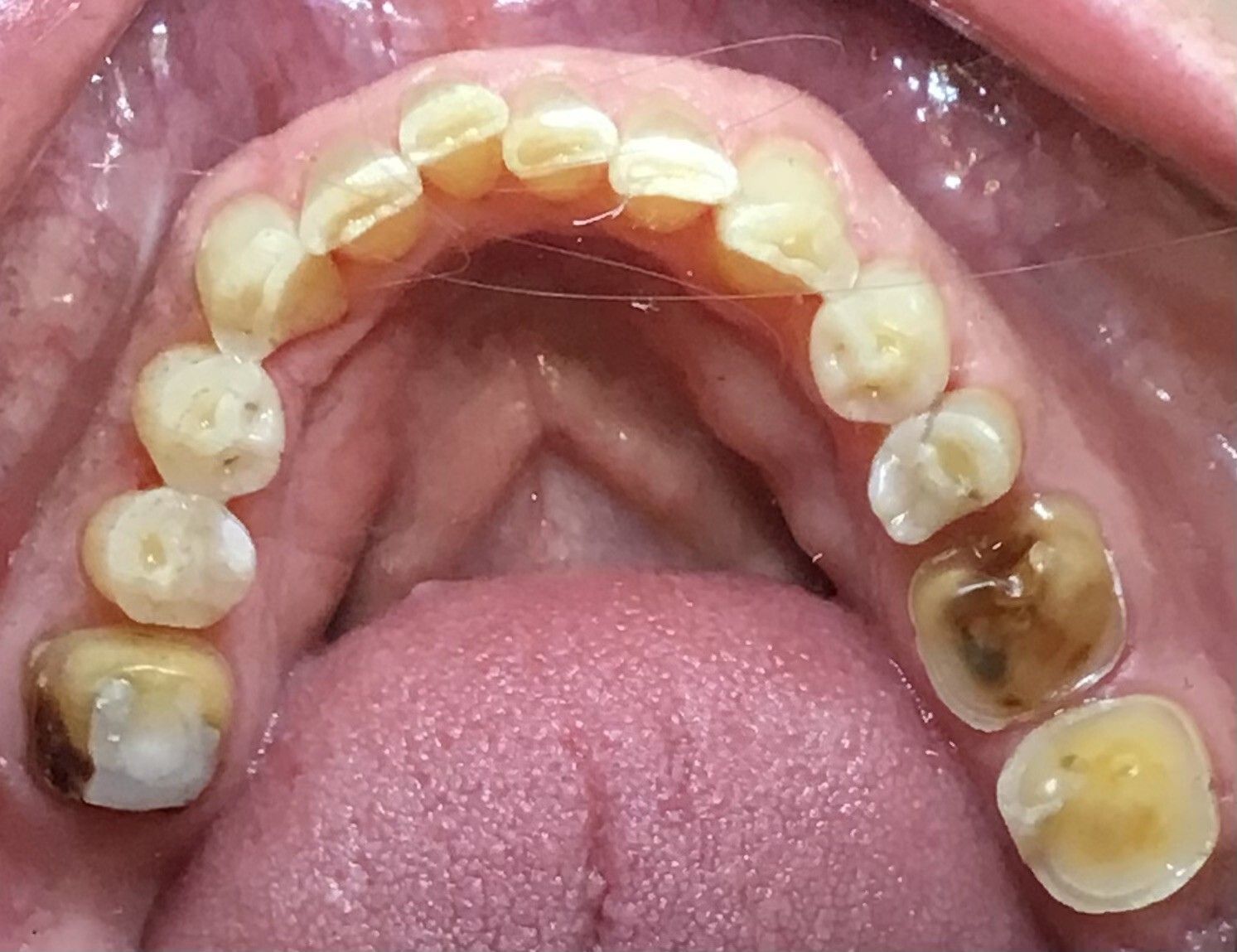 Open mouth showing upper teeth with several cavities and yellow-brown decay