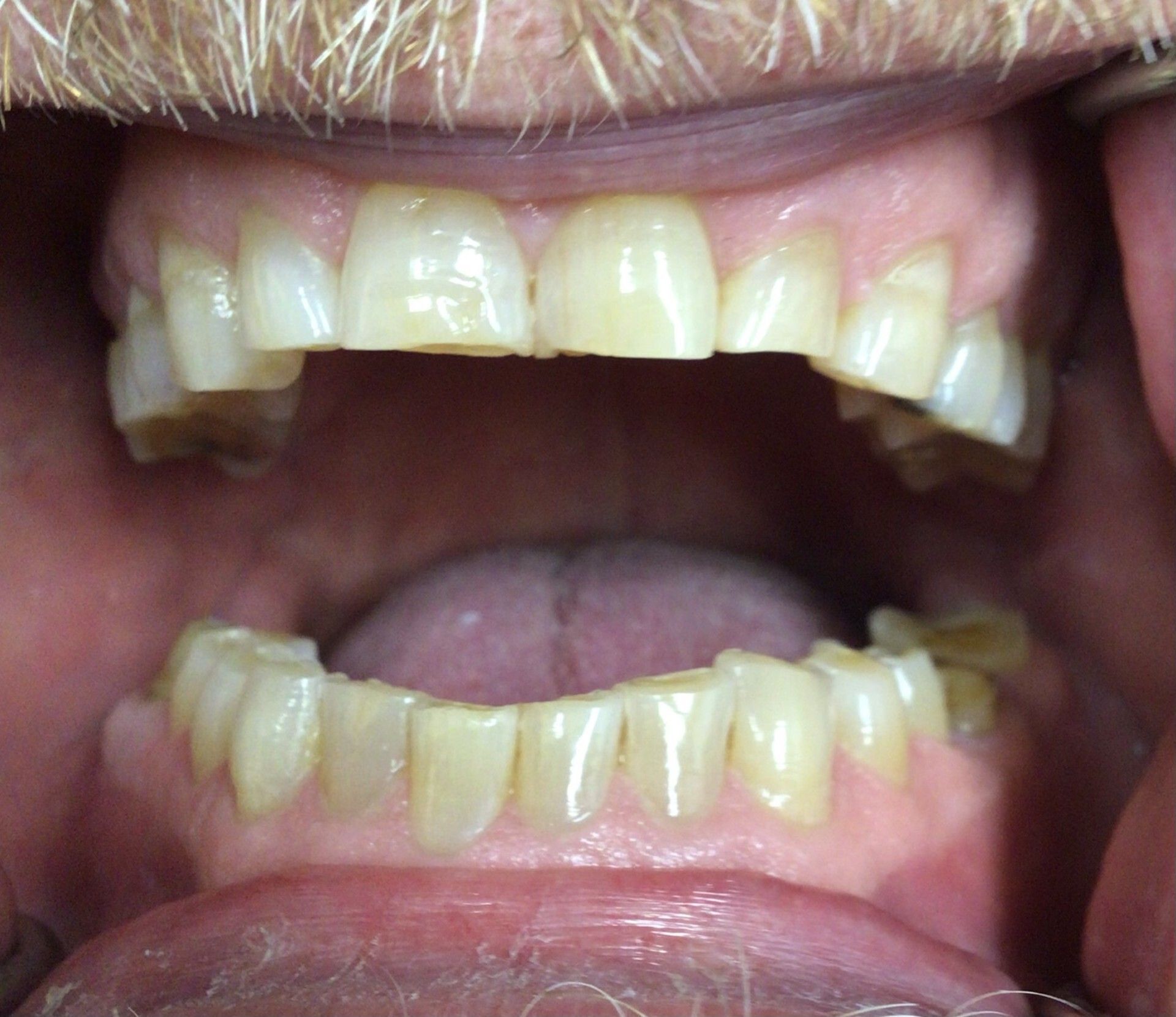 Close-up of an open mouth showing upper and lower teeth with noticeable crowding and discoloration