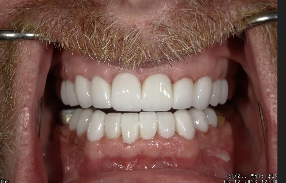 Close-up of a smiling mouth with white teeth and pink gums, lips pulled back with dental retractors