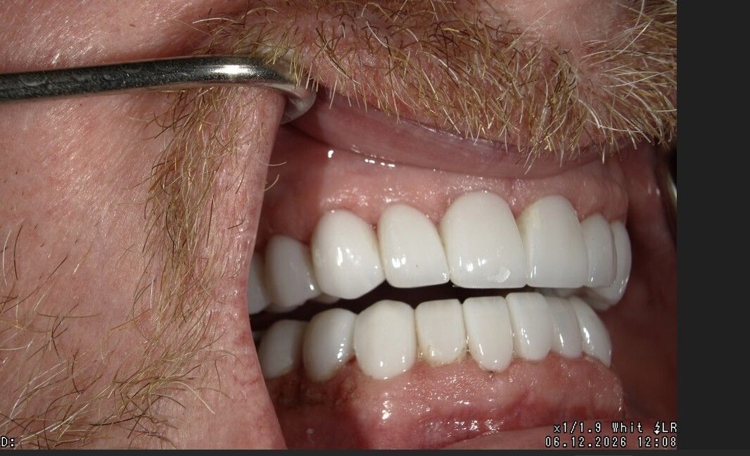 Close-up of a person’s teeth with a dental shade guide comparing white upper and lower teeth.