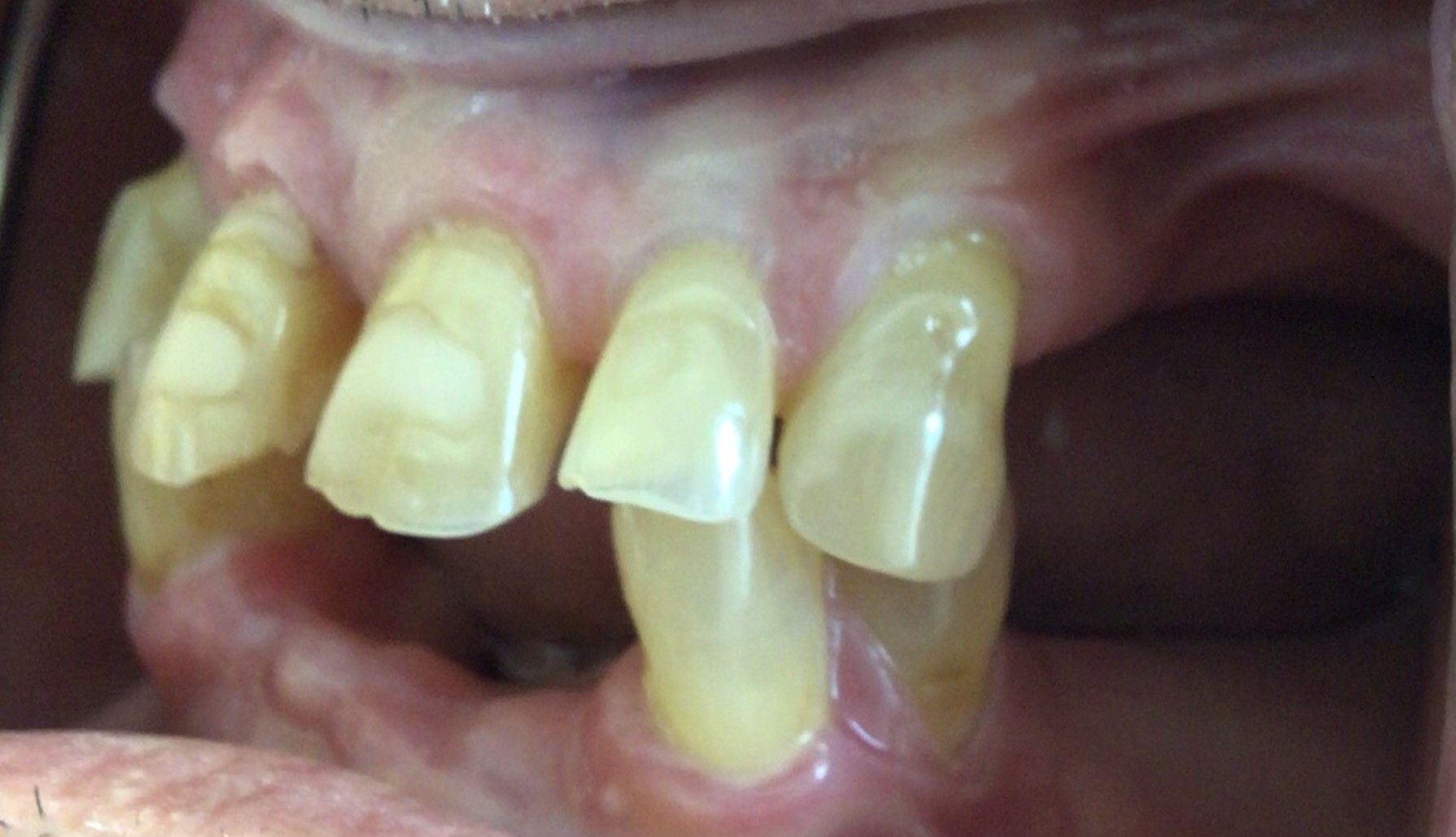 Close-up of upper front teeth with a noticeably crooked, protruding tooth and gaps between teeth.