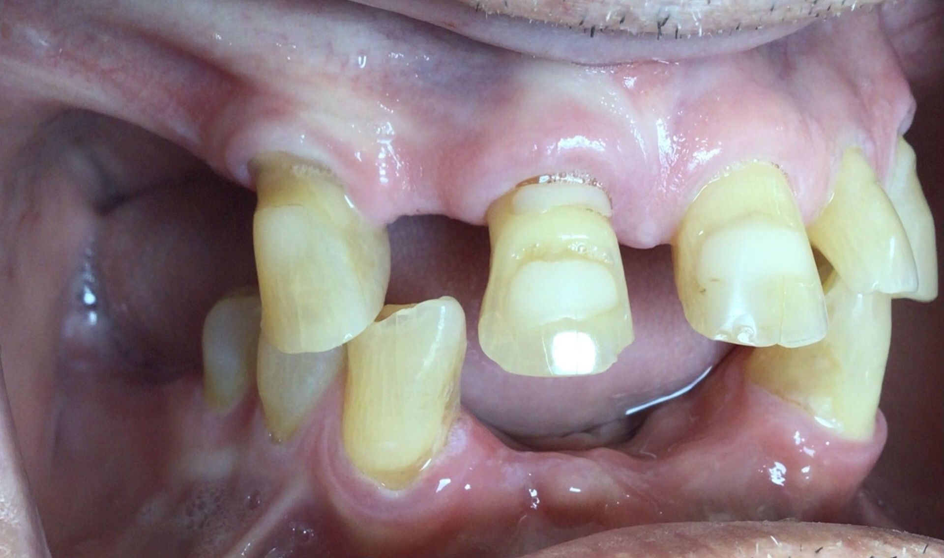 Close-up of severely damaged, yellowed teeth with missing and broken front teeth in a mouth