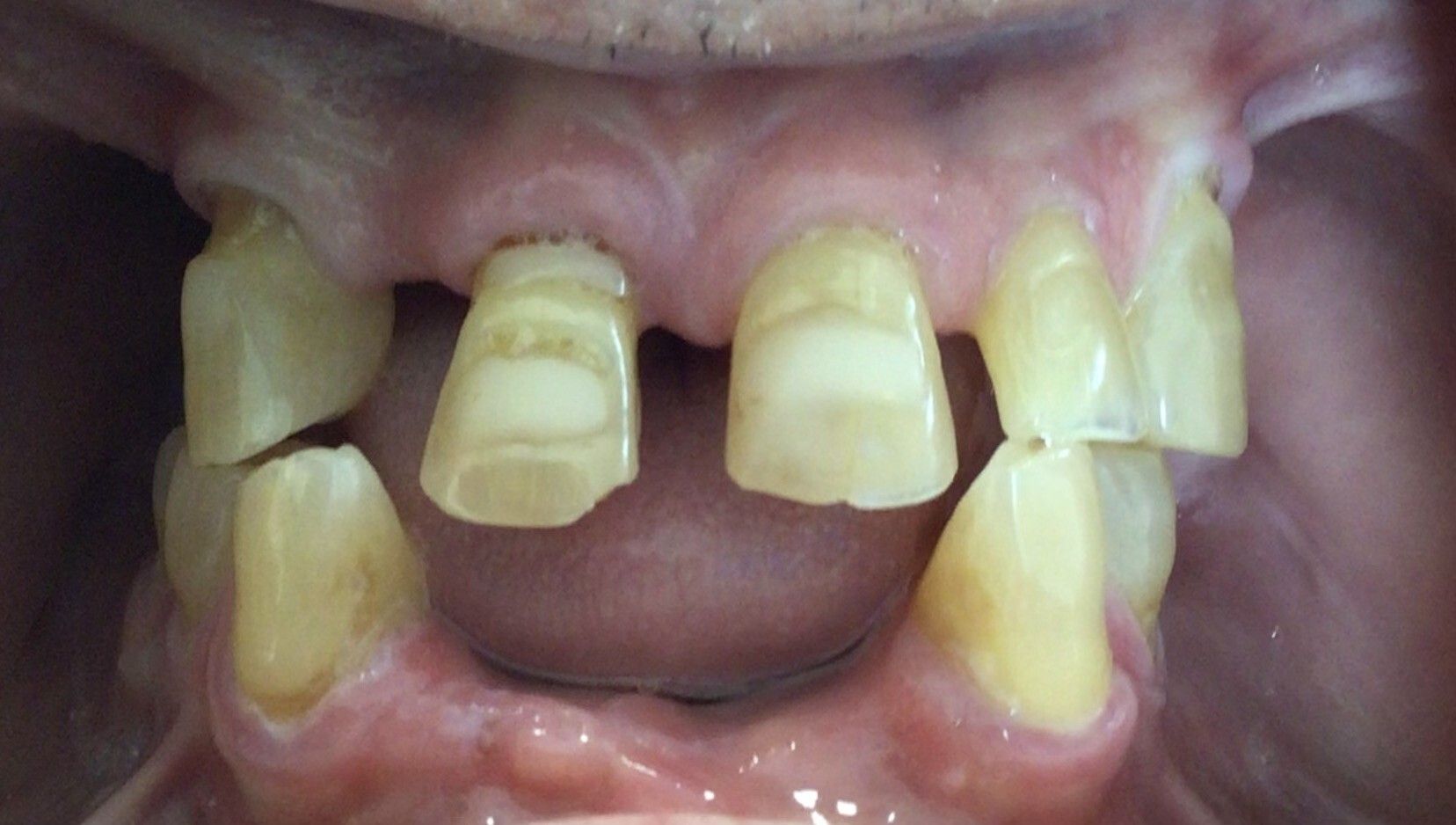 Close-up of a mouth with several broken, discolored front teeth and missing lower teeth