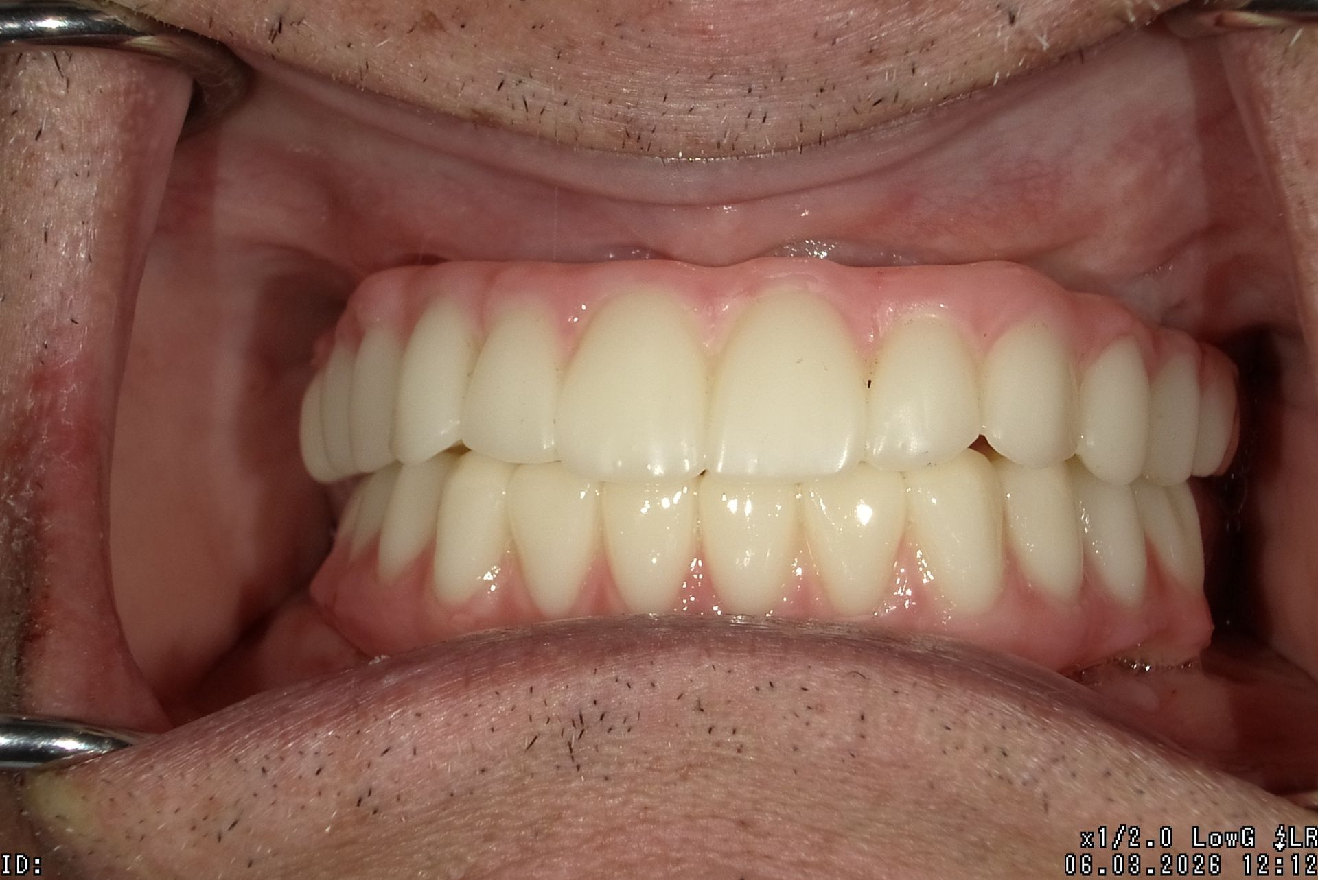 Close-up of a mouth showing white upper and lower dentures fitted in place