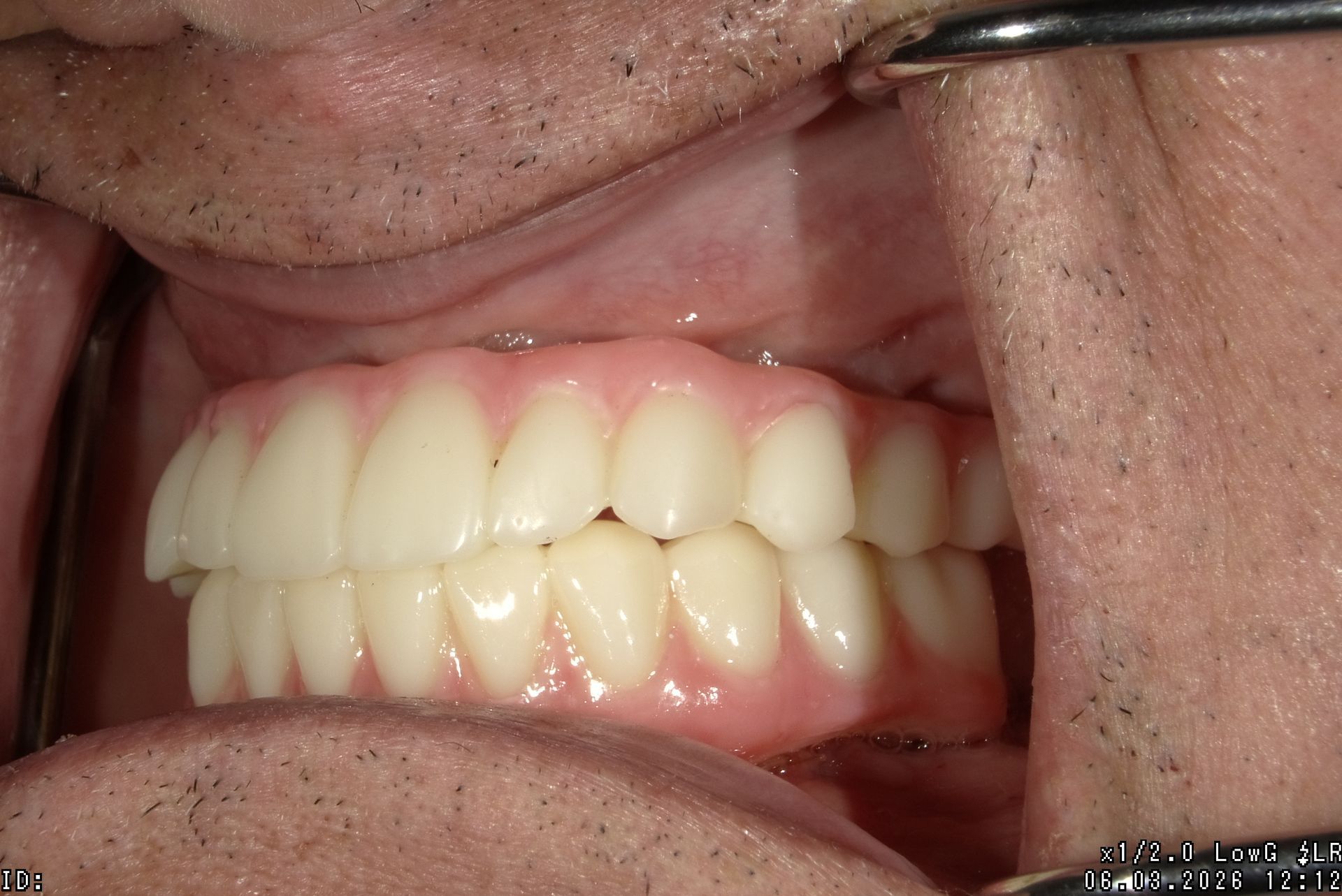 Close-up of a person’s mouth showing teeth and gums in side view during a dental exam