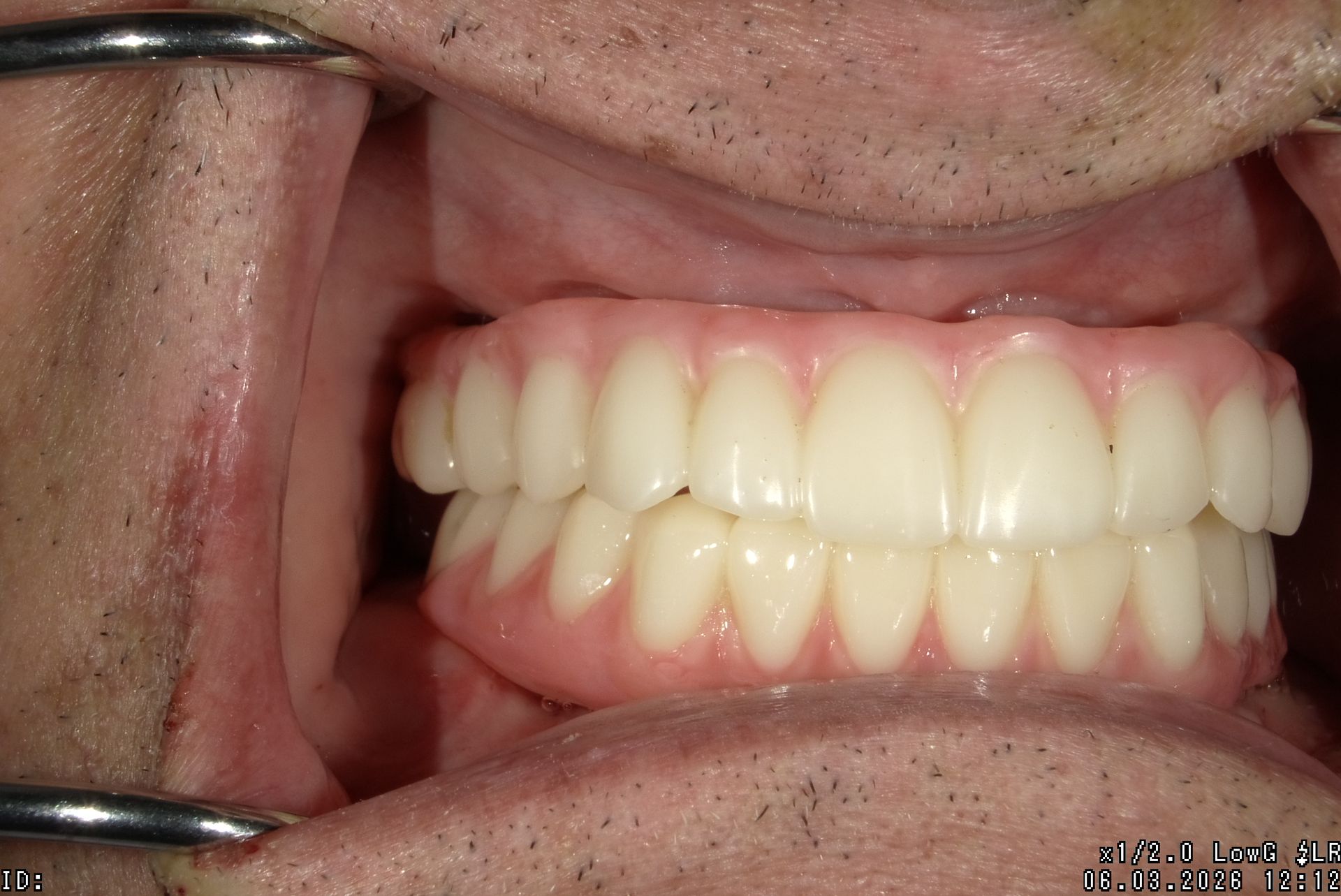Close-up of a person’s open mouth showing teeth and gums, held open with dental tools.