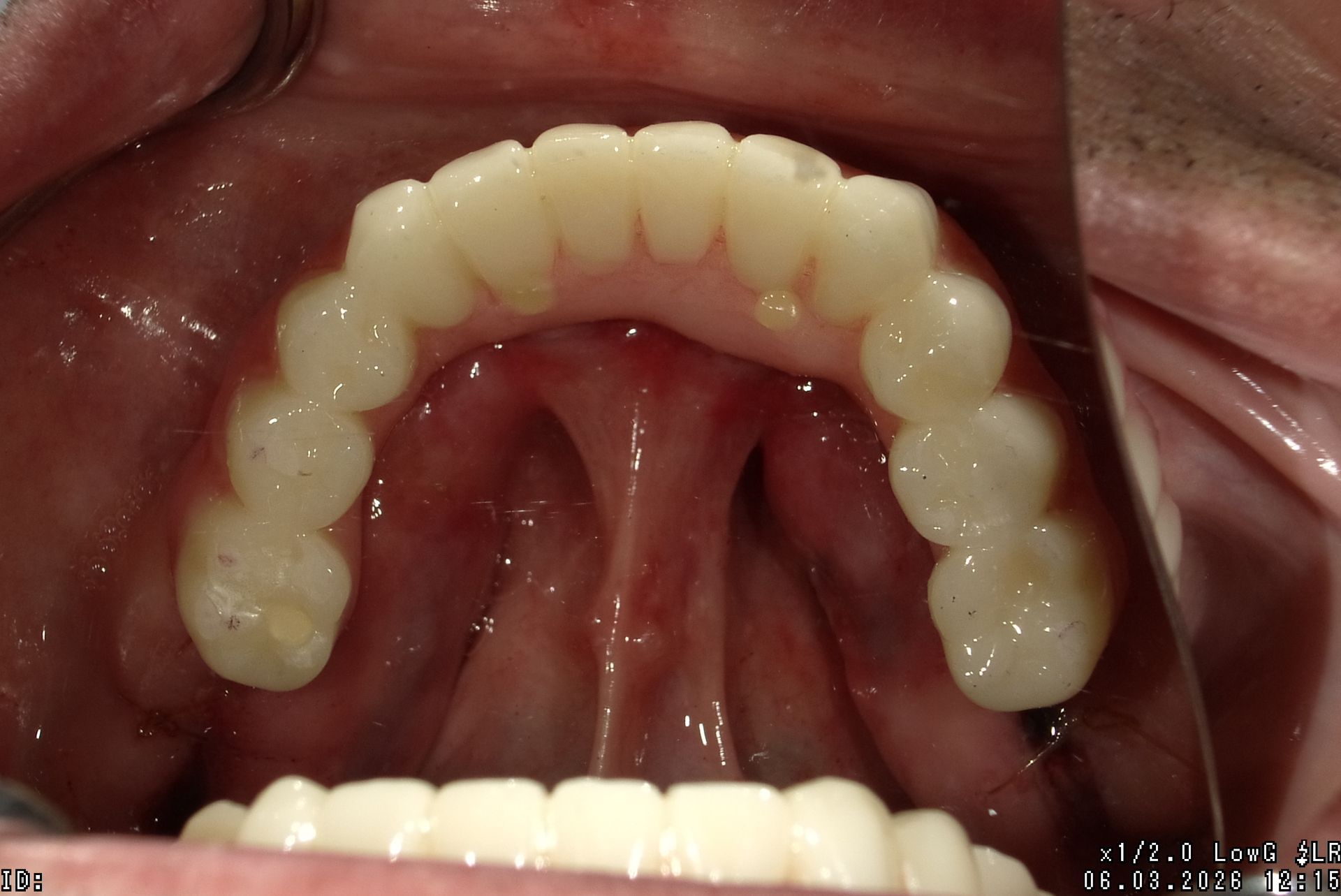 Close-up of an open mouth showing upper teeth and palate during a dental exam