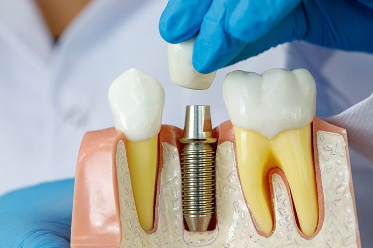 Model of a tooth implant with an artificial tooth being placed by a gloved hand.