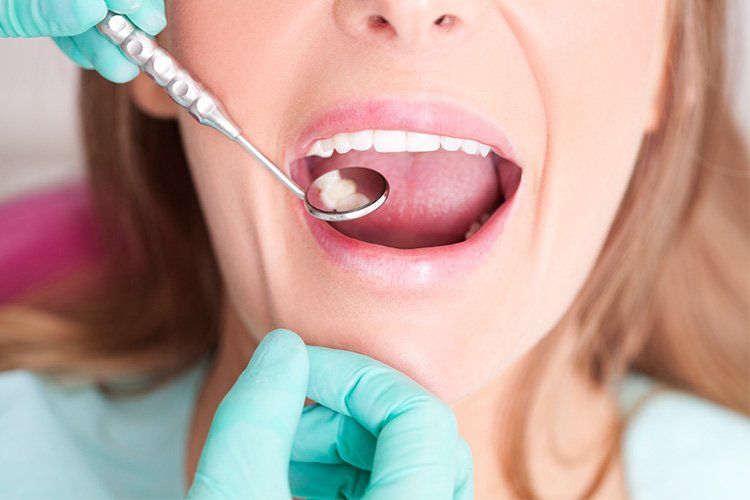 Dentist examining woman's mouth with mirror; showing a cavity.