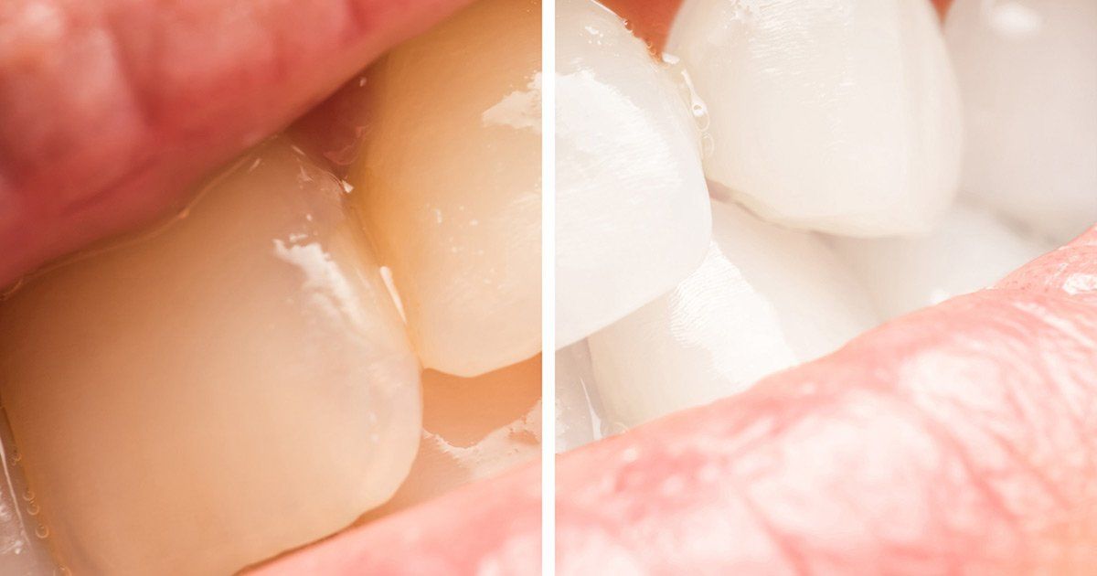 teeth whitening, cosmetic dentistry Georgetown MA