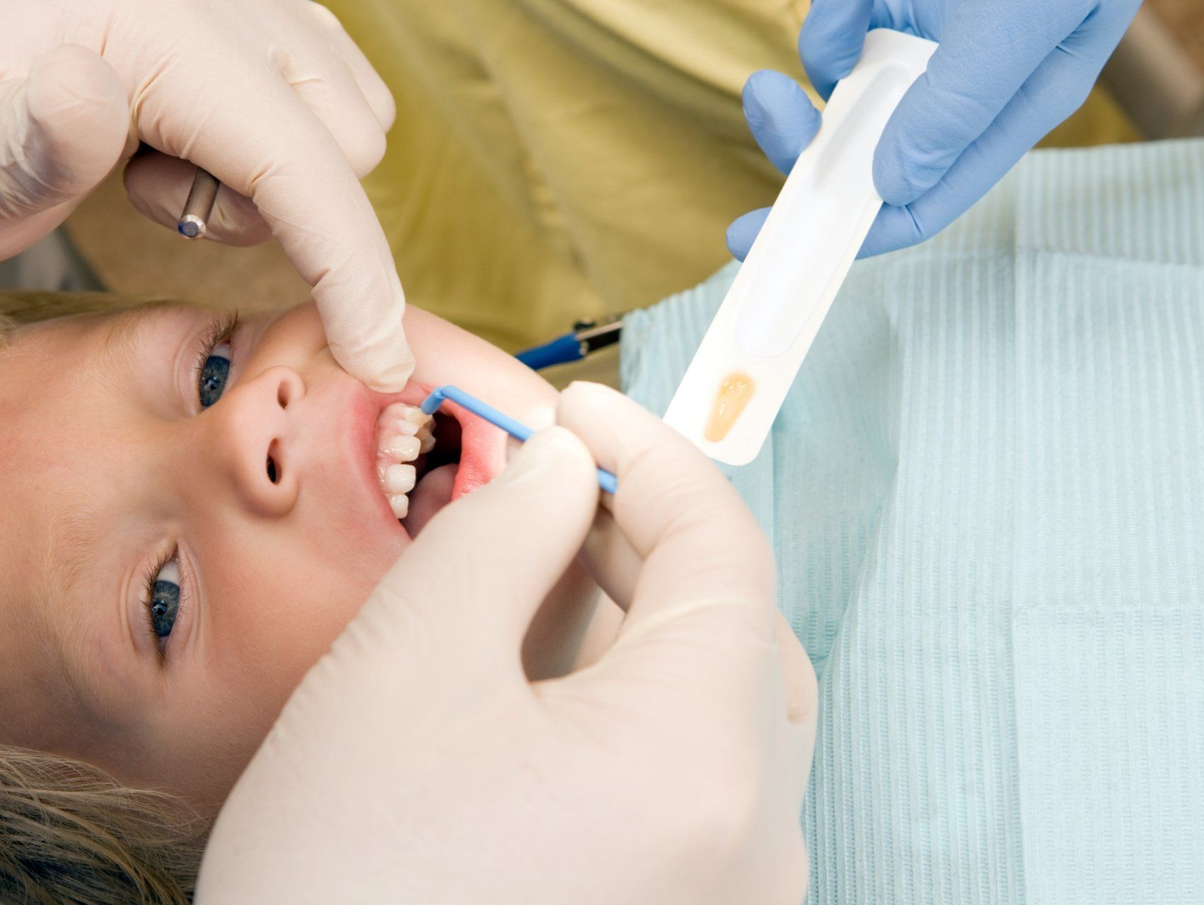 Child receiving dental checkup; dentist applying substance to teeth with gloved hands.