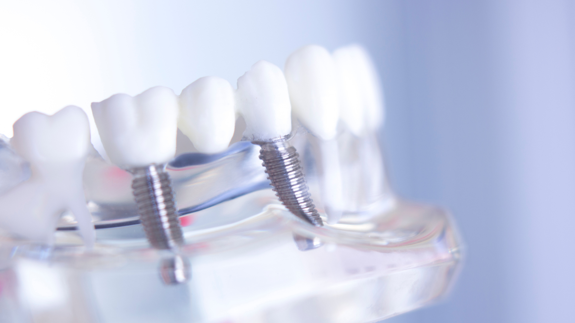 Dental implant model with white crowns and metallic screws on a clear base, in soft blue lighting