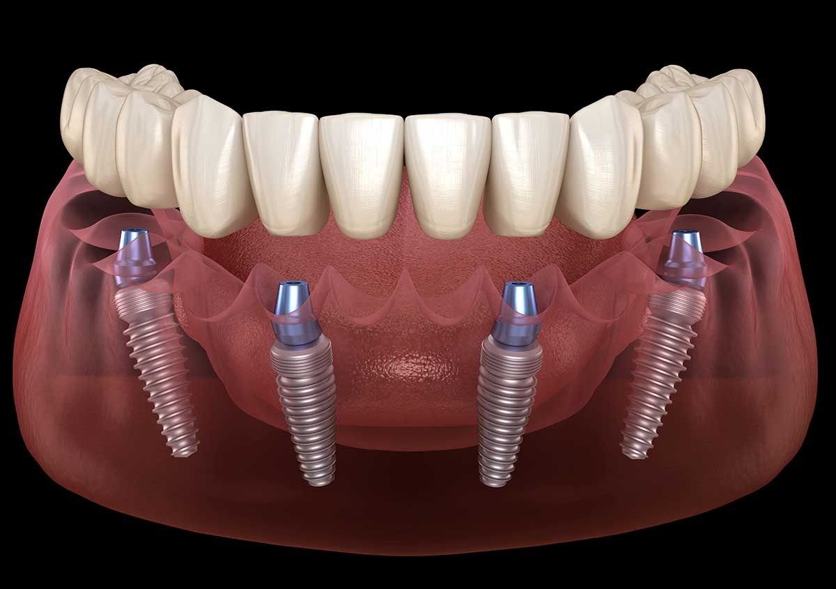 3D dental implant model with full upper teeth and four titanium implants in pink gum tissue