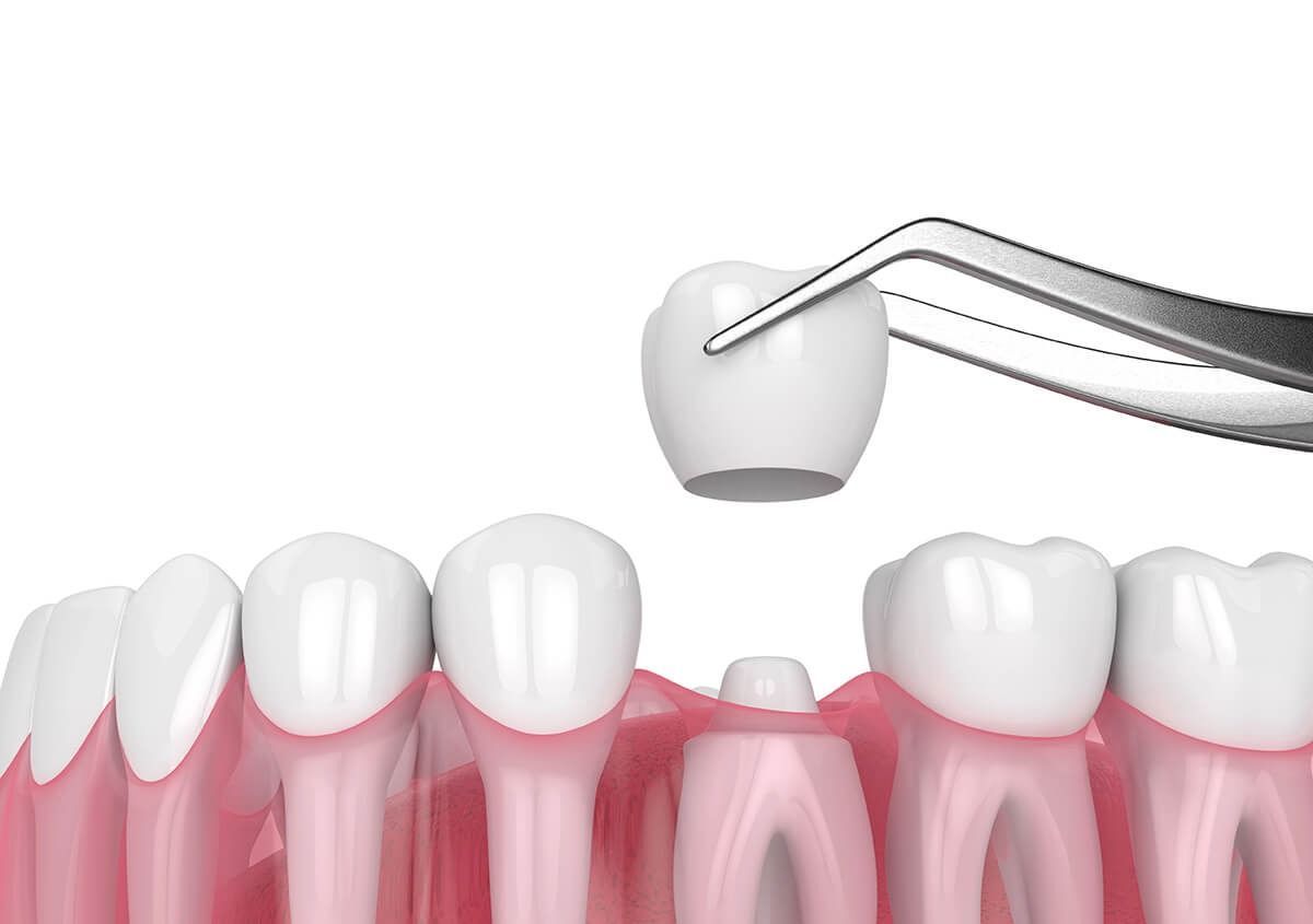 Dental tweezers placing a white tooth onto pink gums among other teeth
