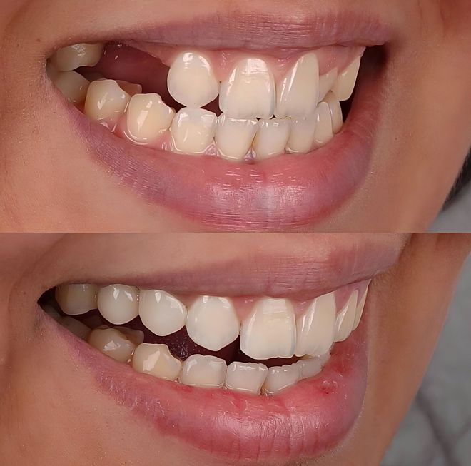 Dental drill applying gold filling to a tooth close-up