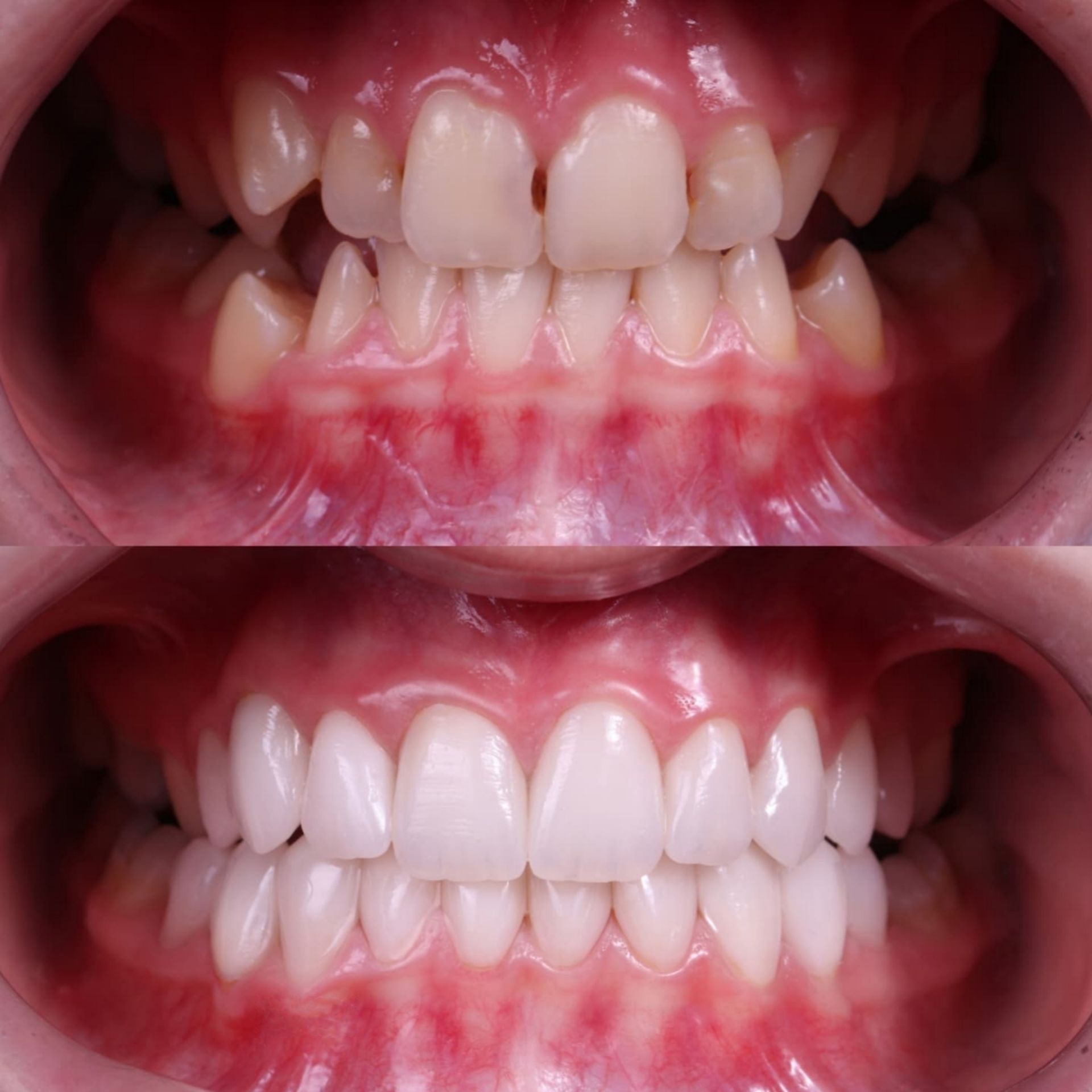Dental implant model with white crowns and metallic screws on a clear base, in soft blue lighting