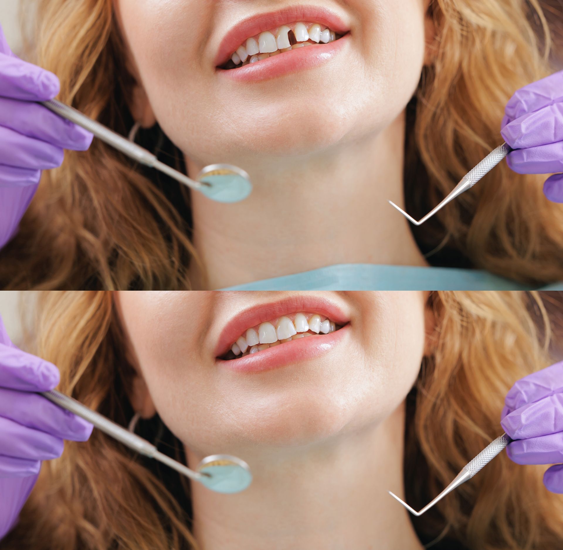 Dental drill applying gold filling to a tooth close-up
