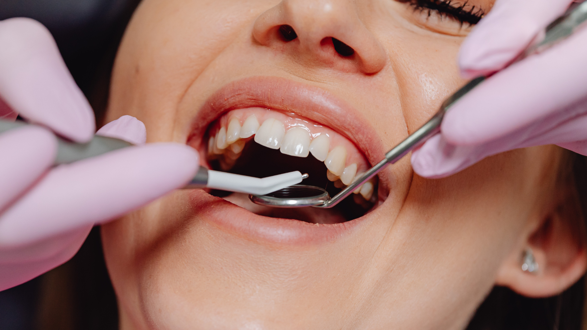 Dentist examining a patient's teeth with tools; person has mouth open; pink gloves.