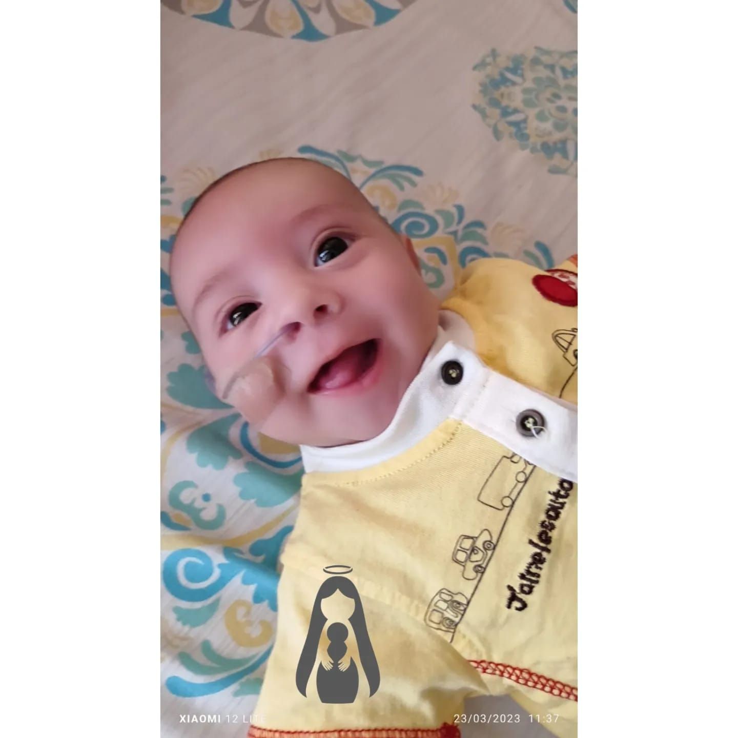 Bebé sonriente con sonda de alimentación, vistiendo una camisa amarilla, acostado sobre una colcha estampada.