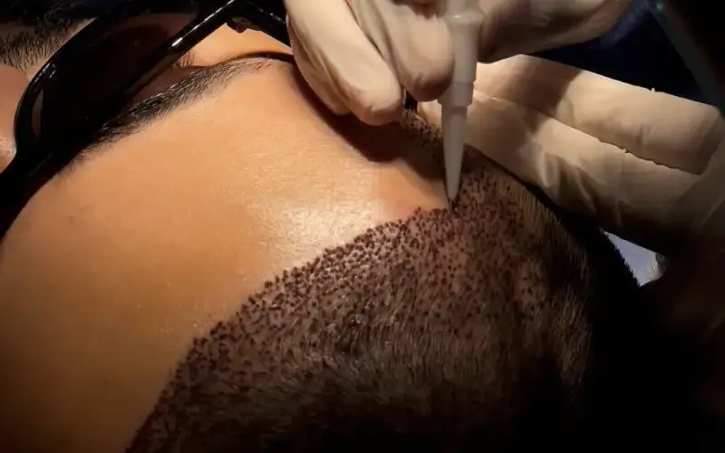 Men having a hair transplant