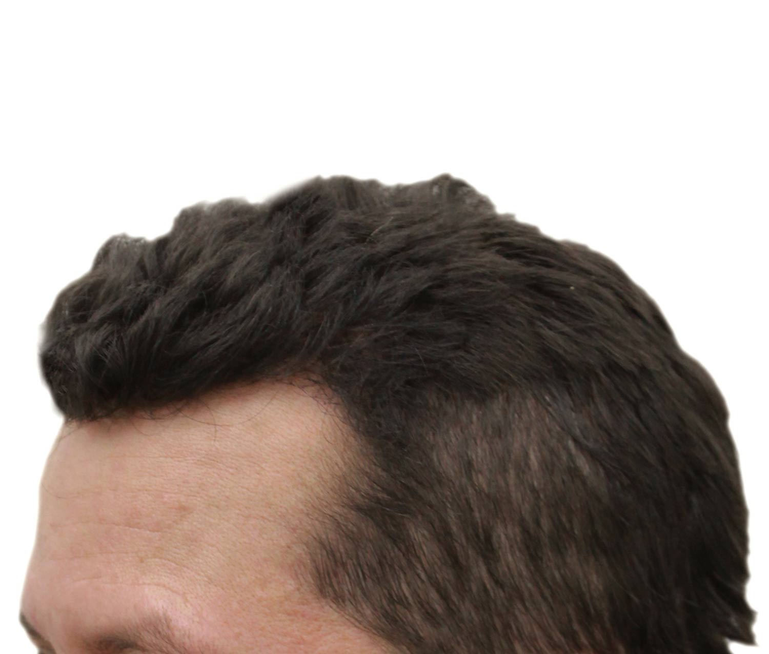 After hair restoration | Real patient, results may vary per individual