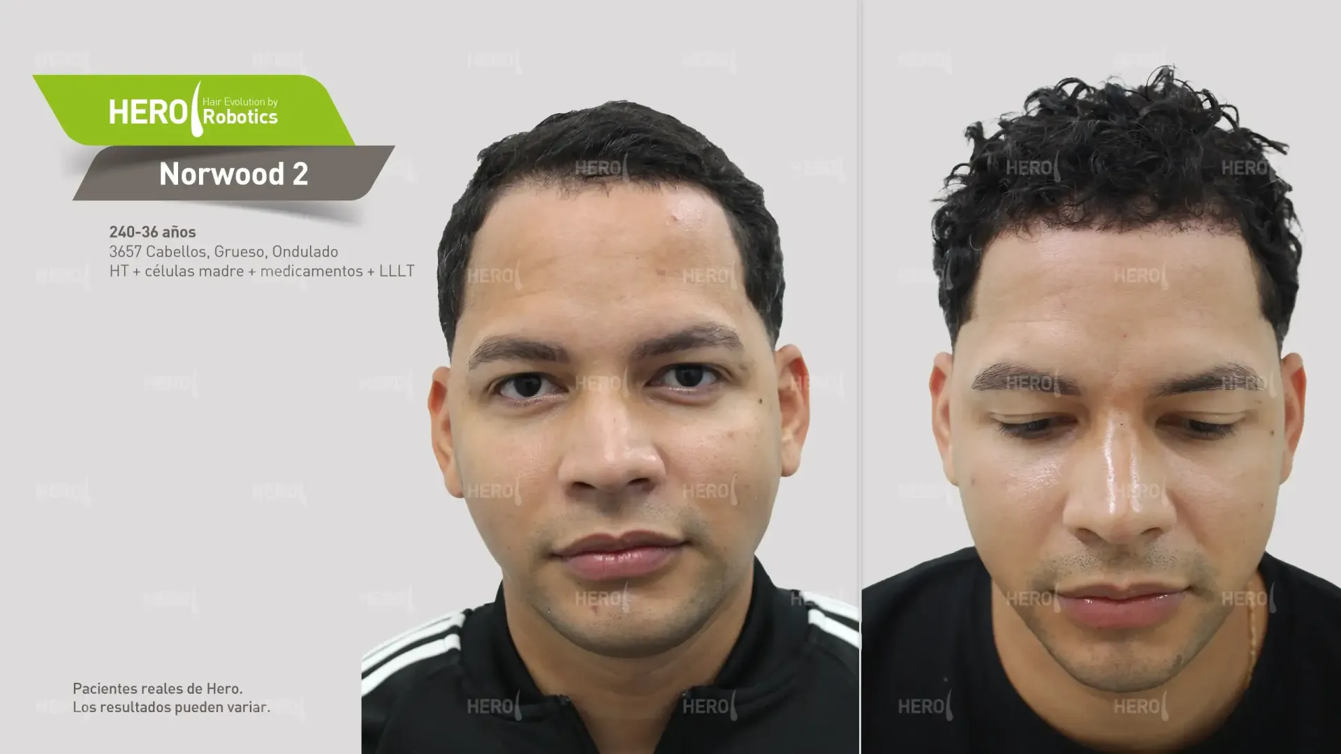 Norwood Level 2: Addressing Early Hairline Recession