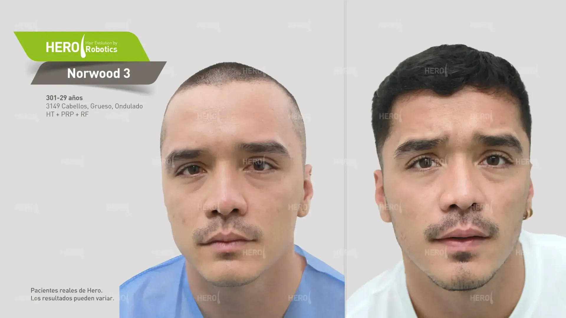 Norwood 4 Hair Restoration