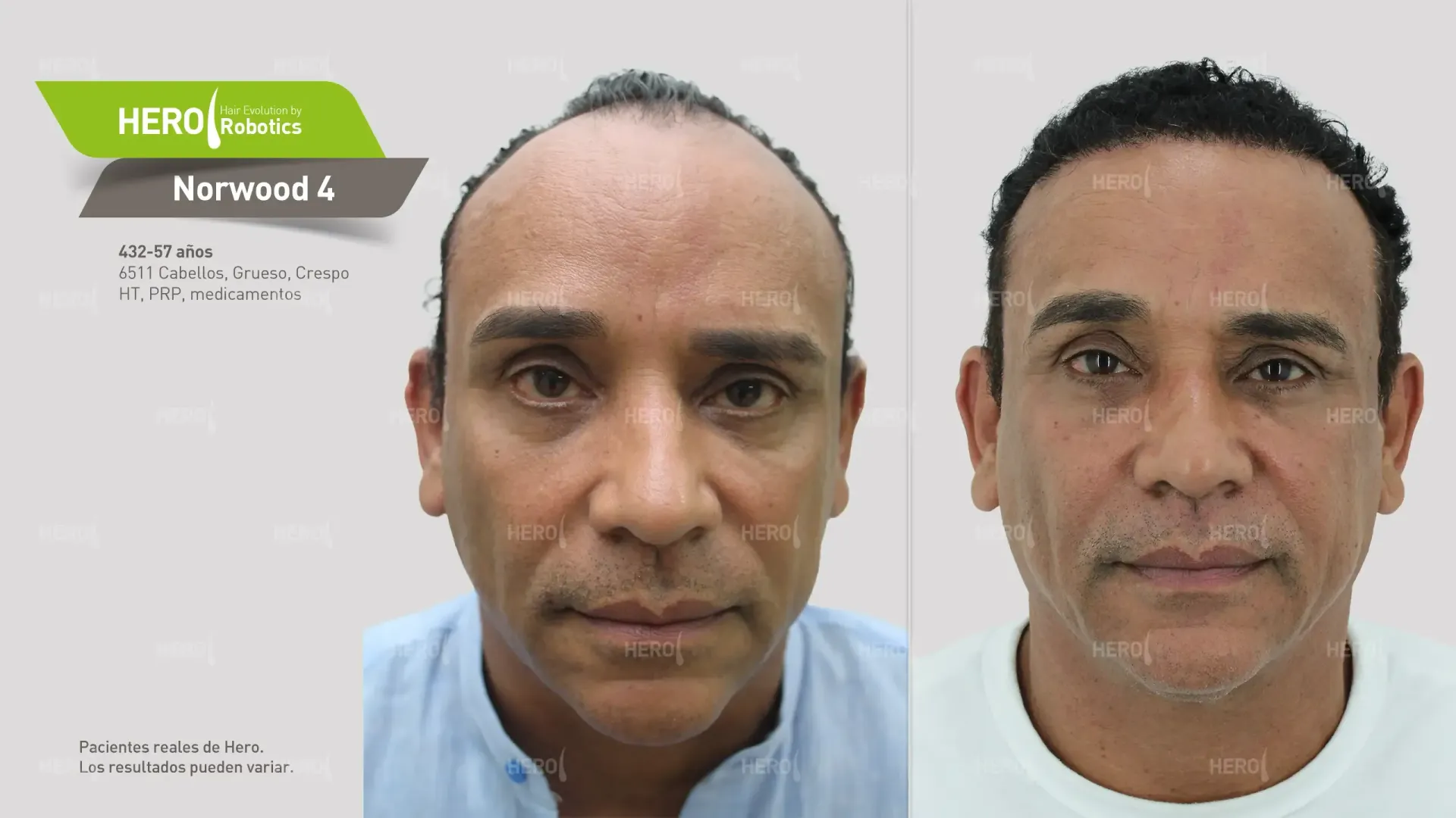 Nivel 4 de Norwood: Tratando la P&eacute;rdida del Cabello