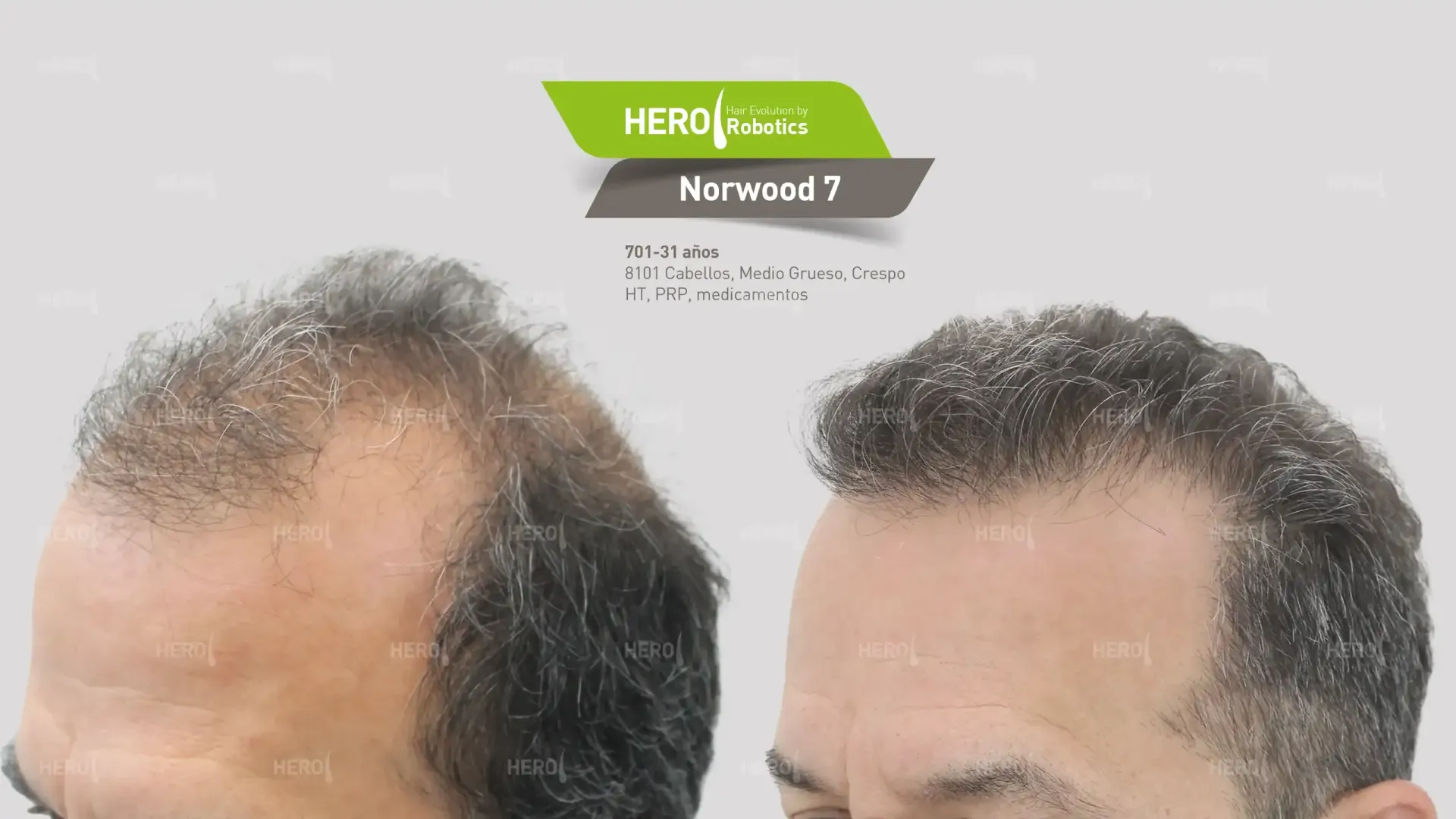 antes y después de trasplante capilar hombre con alopecia Norwood 7