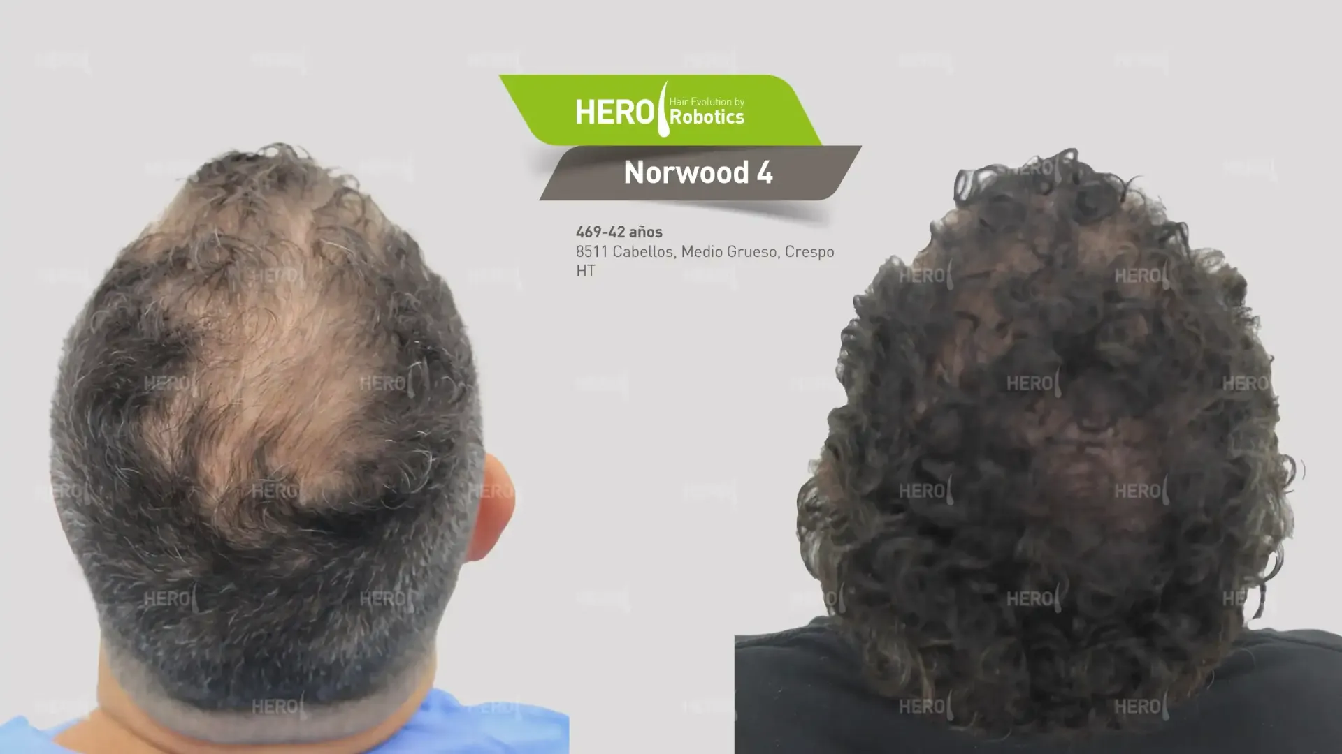 Vertex Alopecia: Effective Solutions for Crown Hair Loss
