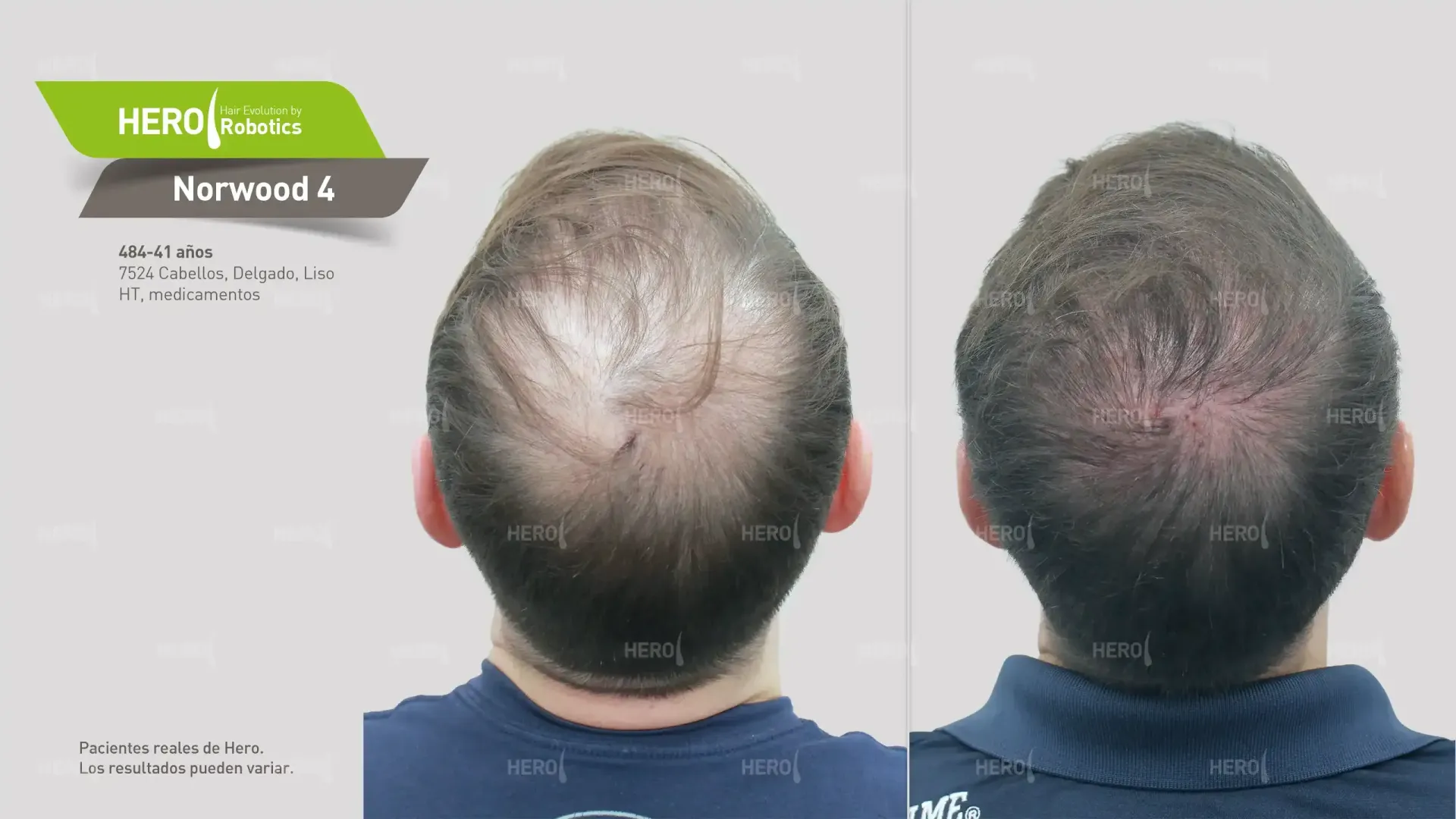 Se muestra la cabeza de un hombre antes y después de un trasplante de cabello.