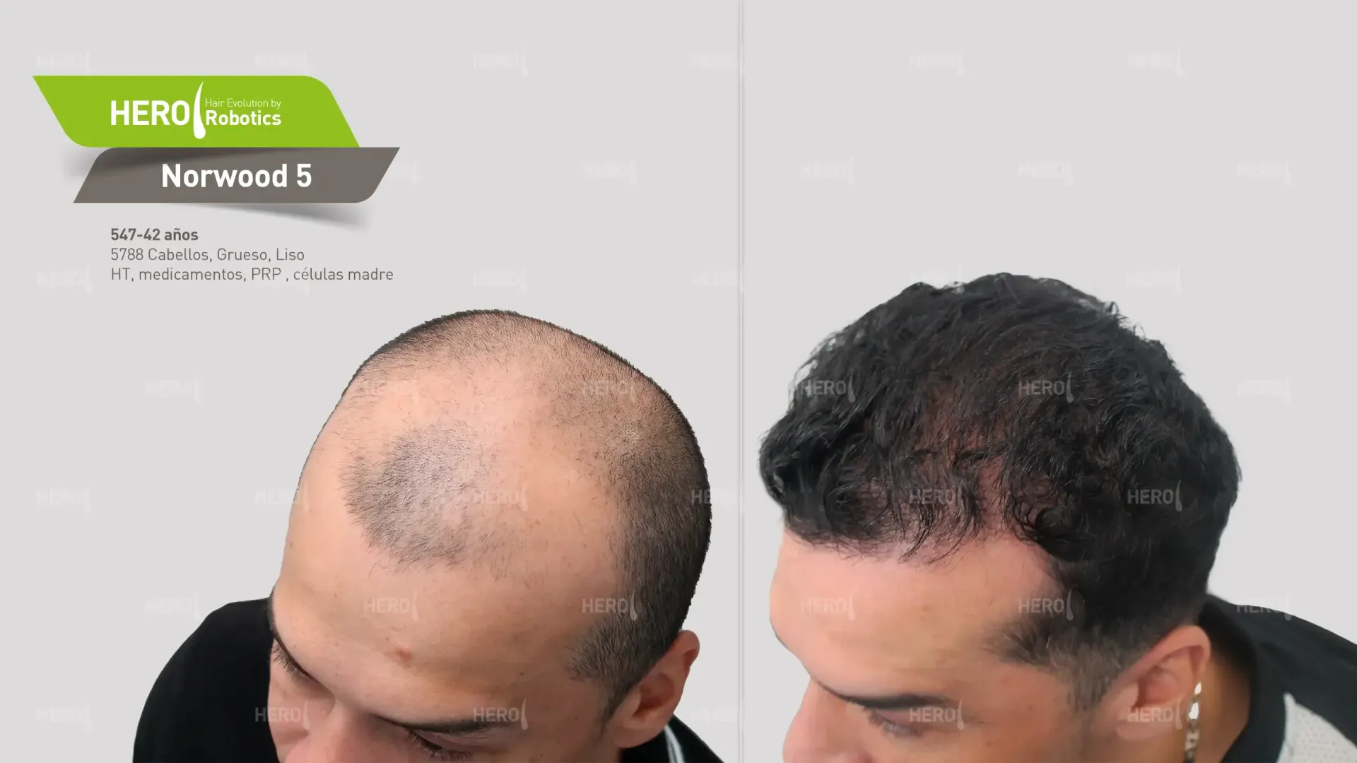 Una foto de antes y después del cabello de un hombre Norwood 5.