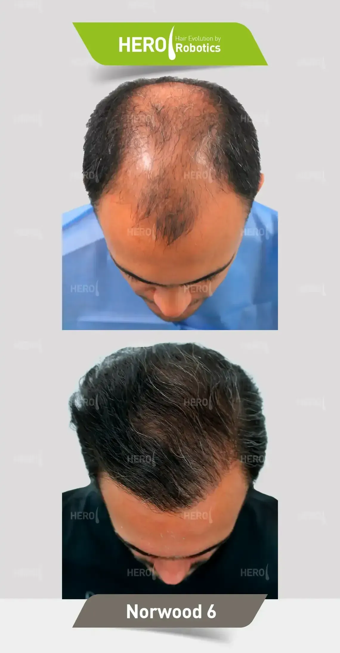 Comparación de antes y después del trasplante de cabello en un hombre, mostrando el crecimiento del cabello.