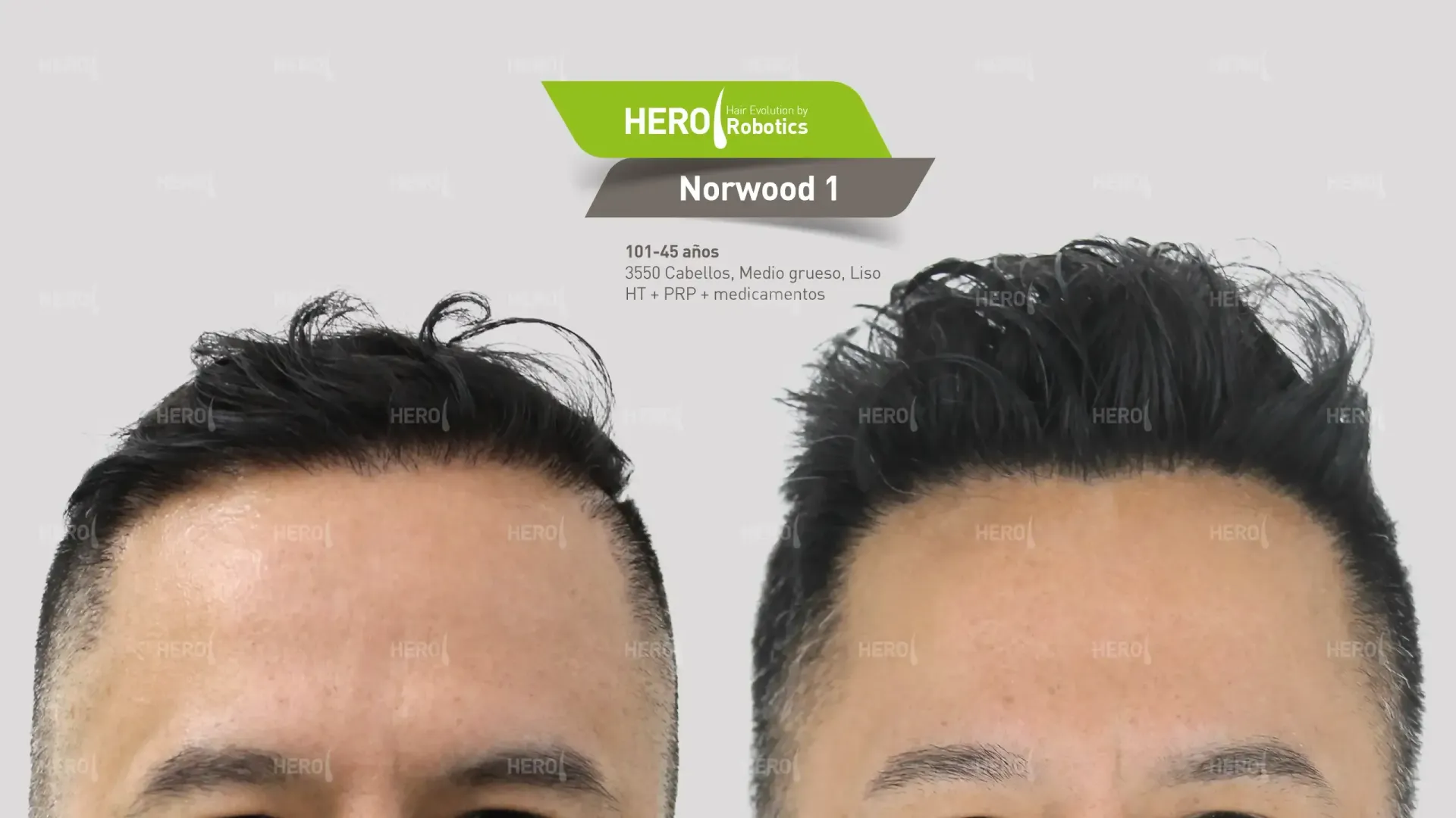 Norwood Level 1: Recognizing Initial Hairline Changes
