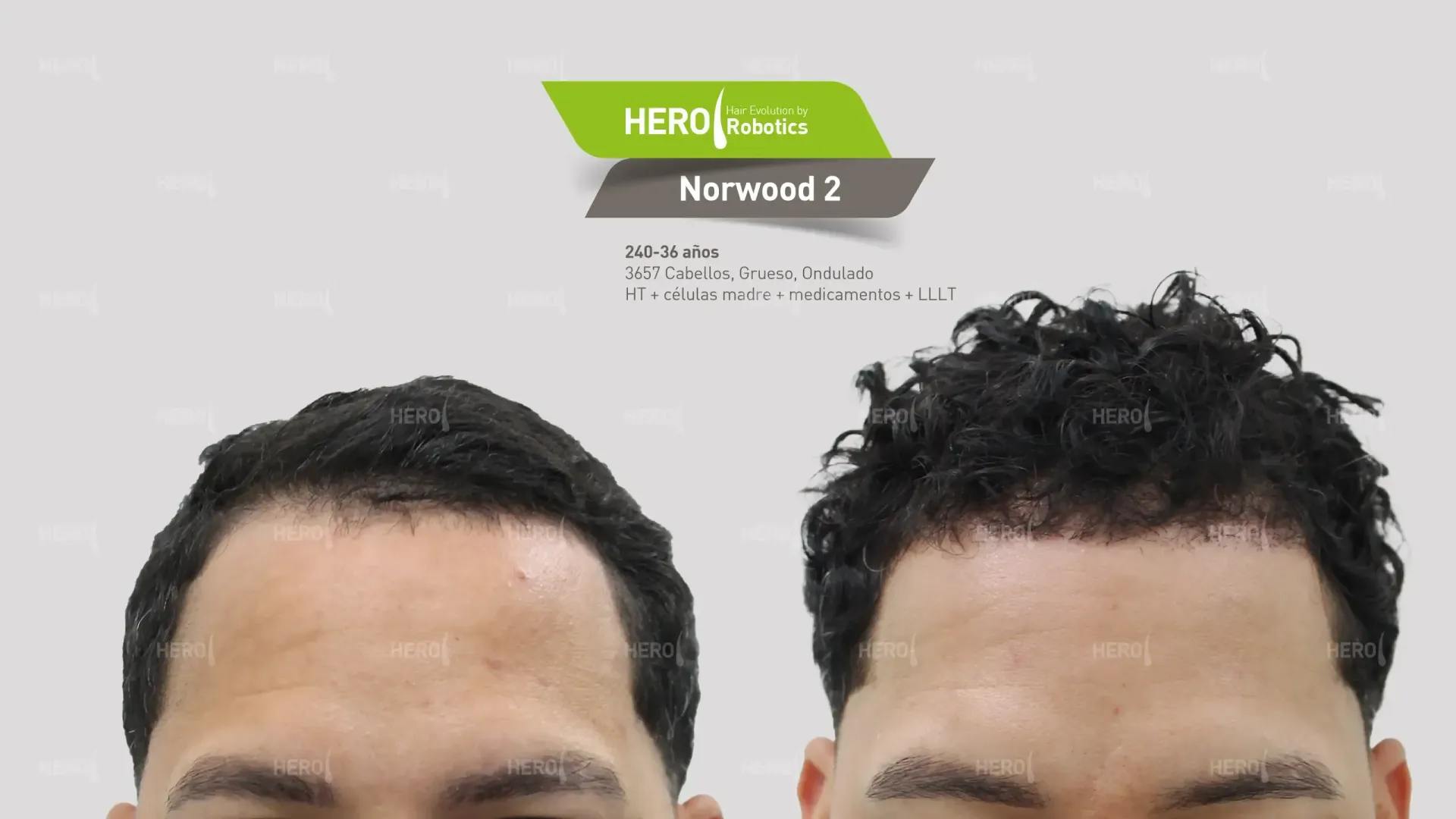 A before and after photo of a man 's hair growth. Norwood level 2